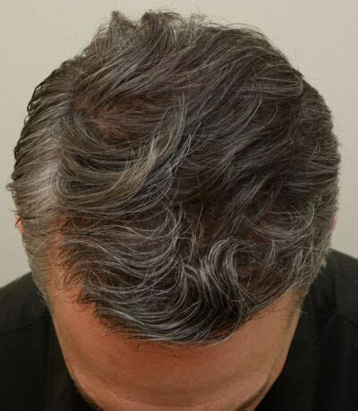 best hair restoration clinic st louis|Dr. Pawlinga .